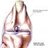 Rotura de Ligamentos